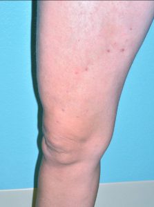 42 year old female after treatment for varicose veins with venefit procedure