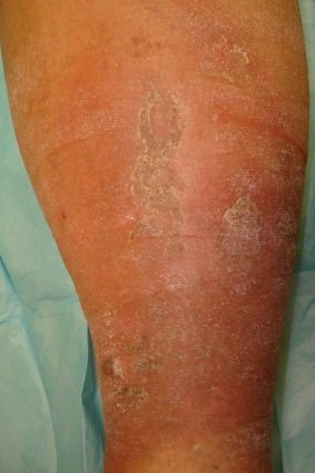 diabetic male prior to treatment - Advanced Vein Care