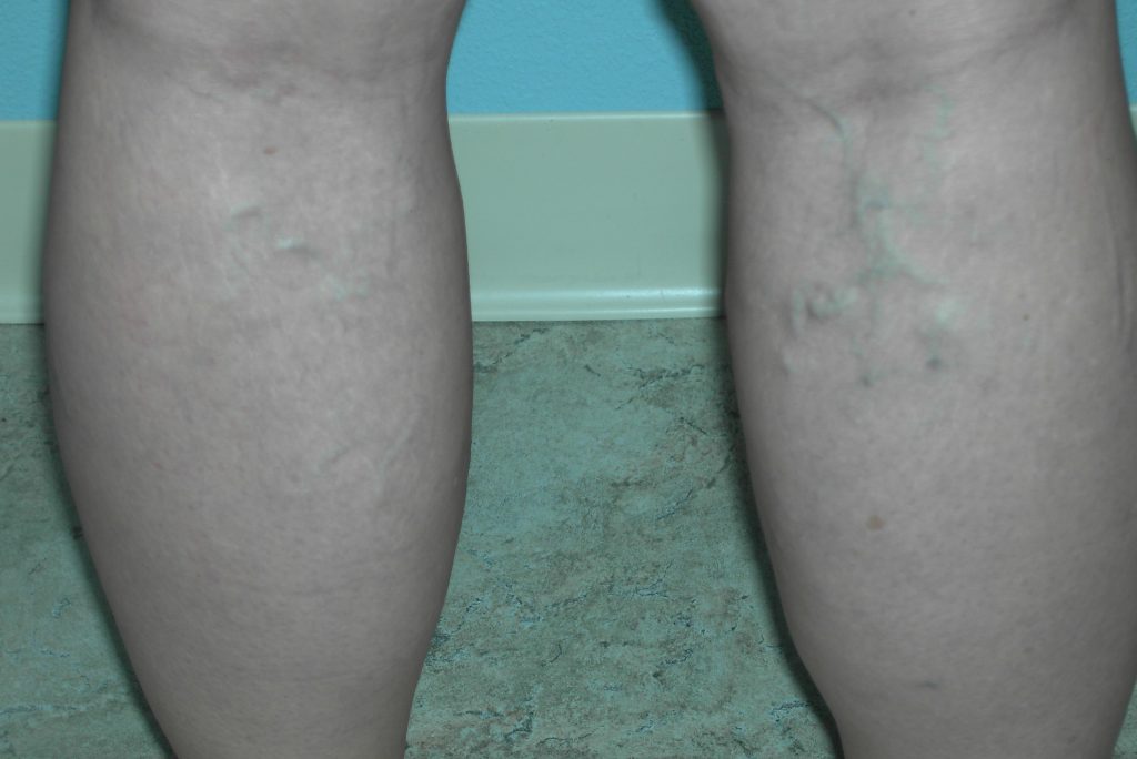 Sclerotherapy for varicose veins worked really well in this patient ...