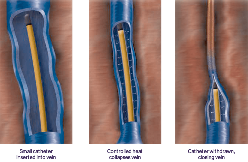 ClosureFast™ Radiofrequency Ablation - Advanced Vein Care